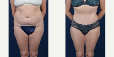 Tummy Tuck before and after photo