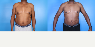 Liposuction before and after photo