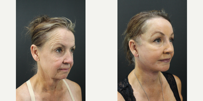 Neck Lift before and after photo