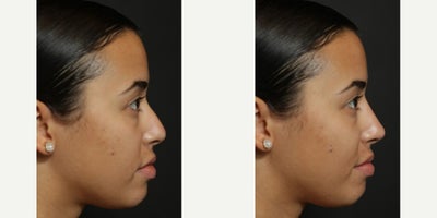 Nonsurgical Nose Job before and after photo