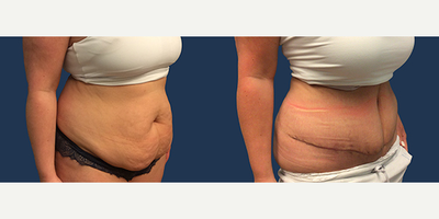 Tummy Tuck before and after photo