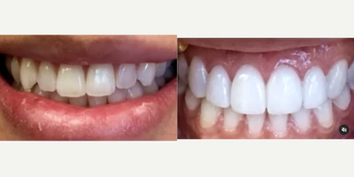 Dental Bonding before and after photo