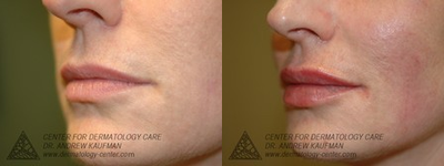 Juvederm before and after photo