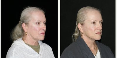 Neck Lift before and after photo