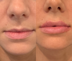Vollure before and after photo