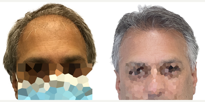 Hair Transplant before and after photo