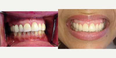 Porcelain Veneers before and after photo
