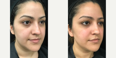Restylane before and after photo