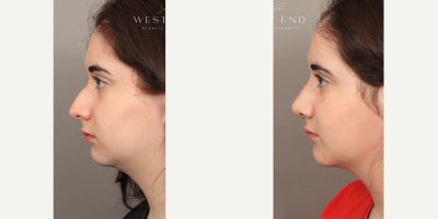 Rhinoplasty before and after photo