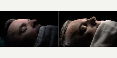 Rhinoplasty before and after photo