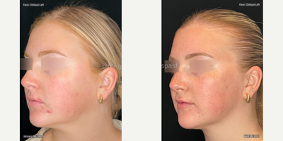 AviClear before and after photo