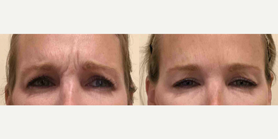 Botox before and after photo