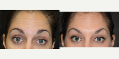 Botox before and after photo