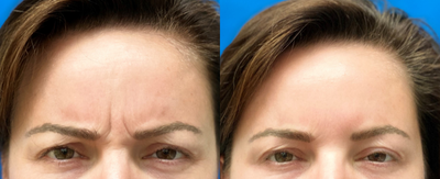 Botox before and after photo