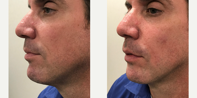 Dermal Fillers before and after photo