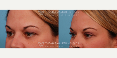 Eyelid Surgery before and after photo