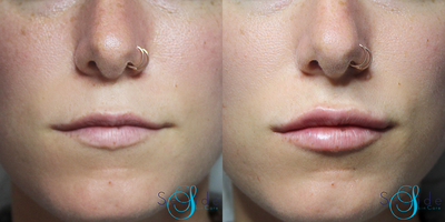 Juvederm before and after photo