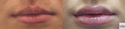 Juvederm before and after photo