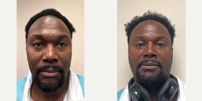 African American Rhinoplasty before and after photo