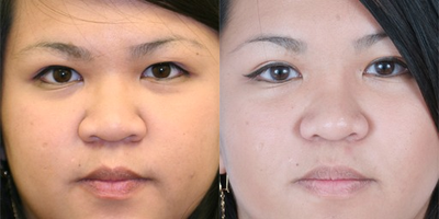 Asian Rhinoplasty before and after photo
