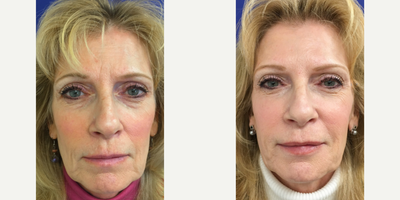 Dermal Fillers before and after photo