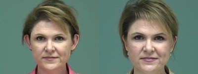 Ear Surgery before and after photo