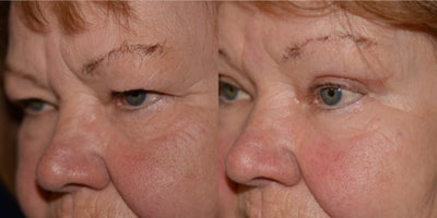 Eyelid Surgery before and after photo
