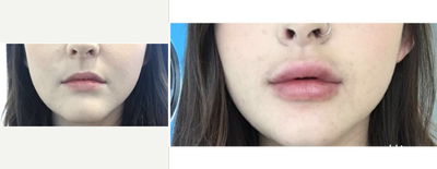 Lip Fillers before and after photo