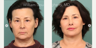 Eyelid Surgery before and after photo