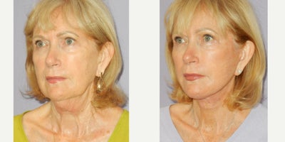Facelift before and after photo