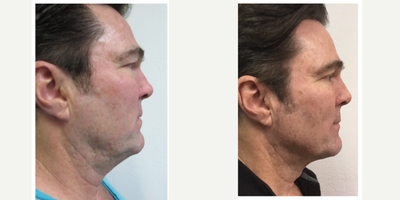 Kybella before and after photo