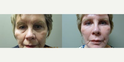 Laser Resurfacing before and after photo