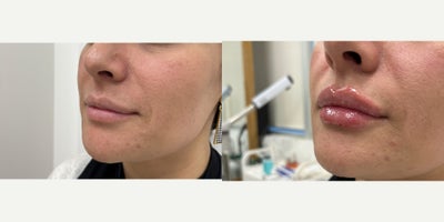 Lip Fillers before and after photo