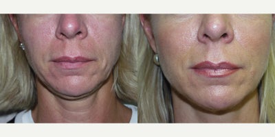 Liposculpture before and after photo