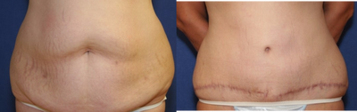 Tummy Tuck before and after photo
