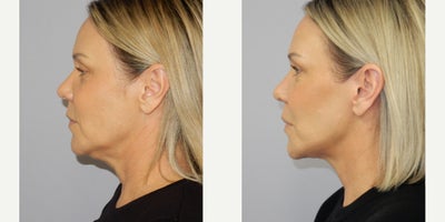 before and after image