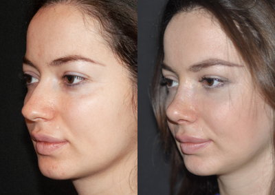 Rhinoplasty before and after photo