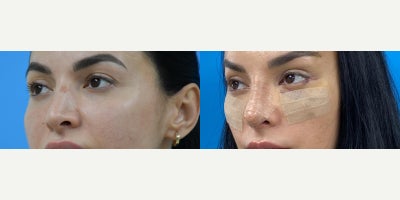 Brow Lift before and after photo