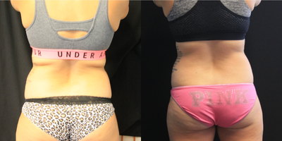 CoolSculpting before and after photo