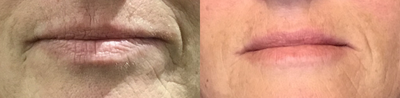 Dermal Fillers before and after photo