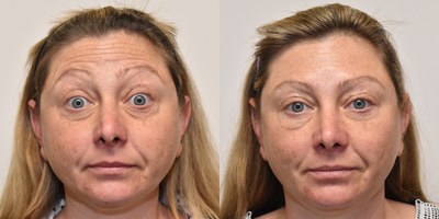Dysport before and after photo