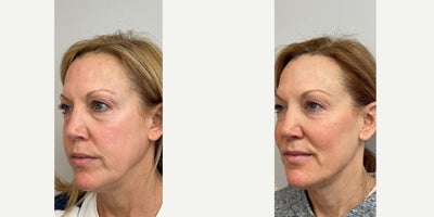 Morpheus8 before and after photo