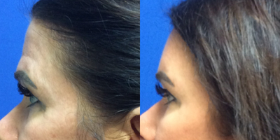 Voluma before and after photo