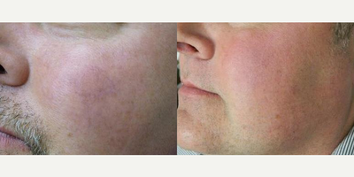 IPL before and after photo
