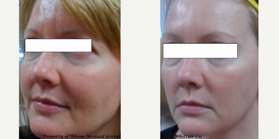 Nonsurgical Facelift before and after photo