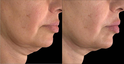 Ultherapy before and after photo