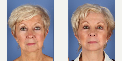 Facelift before and after photo