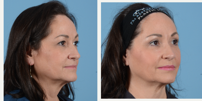 Facial Fat Transfer before and after photo