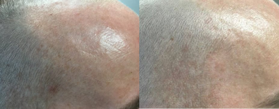 Laser Resurfacing before and after photo
