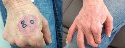 Mohs Surgery before and after photo